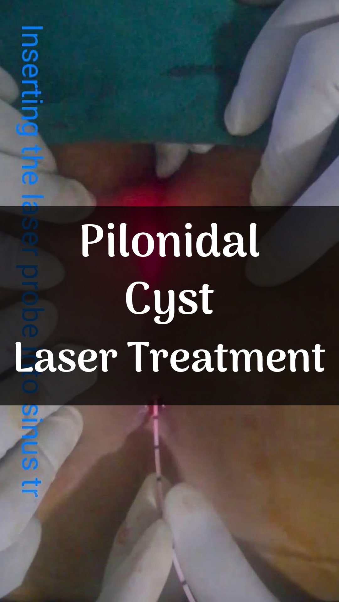 Pilonidal Cyst Treatment - Gwinnett Surgical Specialists